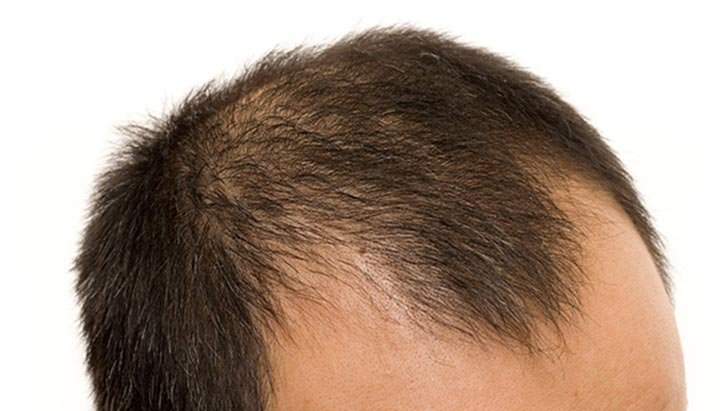 Androgenic Alopecia Treatment Process